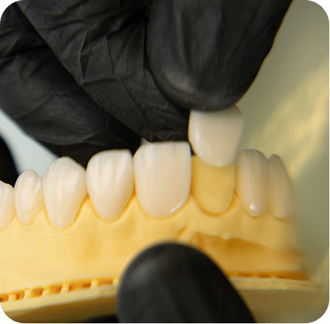 precisa desgastar dentes para porcelana